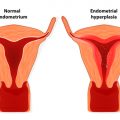 Endometrium - norma, budowa, choroby
