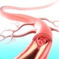 Arterioskleroza - miażdzyca naczyń wieńcowych