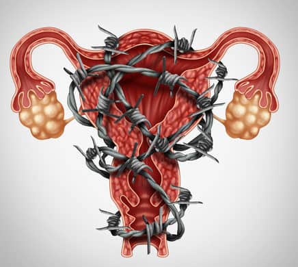 Endometrioza czyli gruczolistość; definicja, przyczyny, objawy, stopnie